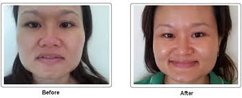 Diy face mask for irritated skin